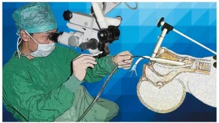 CO₂激光激光在喉显微外科中的应用