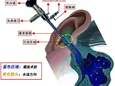持续灌流耳内镜外科(CIM-EES)广受行业推崇的核心原因